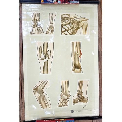 94 - St John's Ambulance educational poster: 'Dislocation' 76cm x 60cm, 'Fractures' 88cm x 54cm (damage t... 