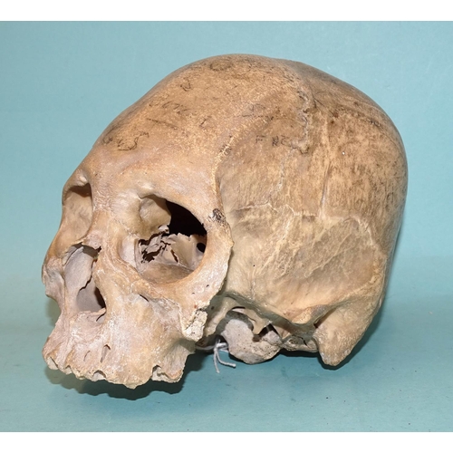 450 - An antique human skull, (a/f, lower mandible and zygomatic arches lacking).