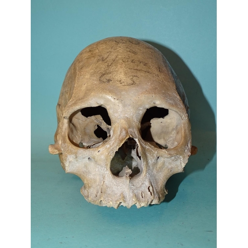 450 - An antique human skull, (a/f, lower mandible and zygomatic arches lacking).