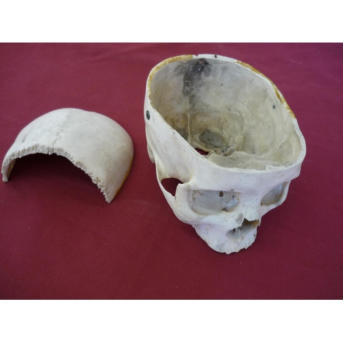 39 - Medical research type genuine human skull with cut away section