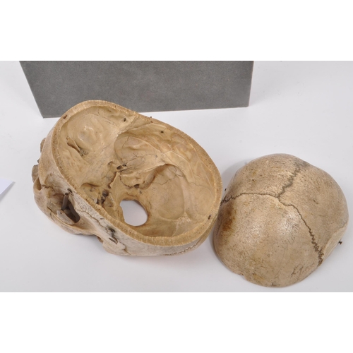 202 - Anatomy / Medical Interest - An early 20th century Edwardian female human skull. The skull having br... 